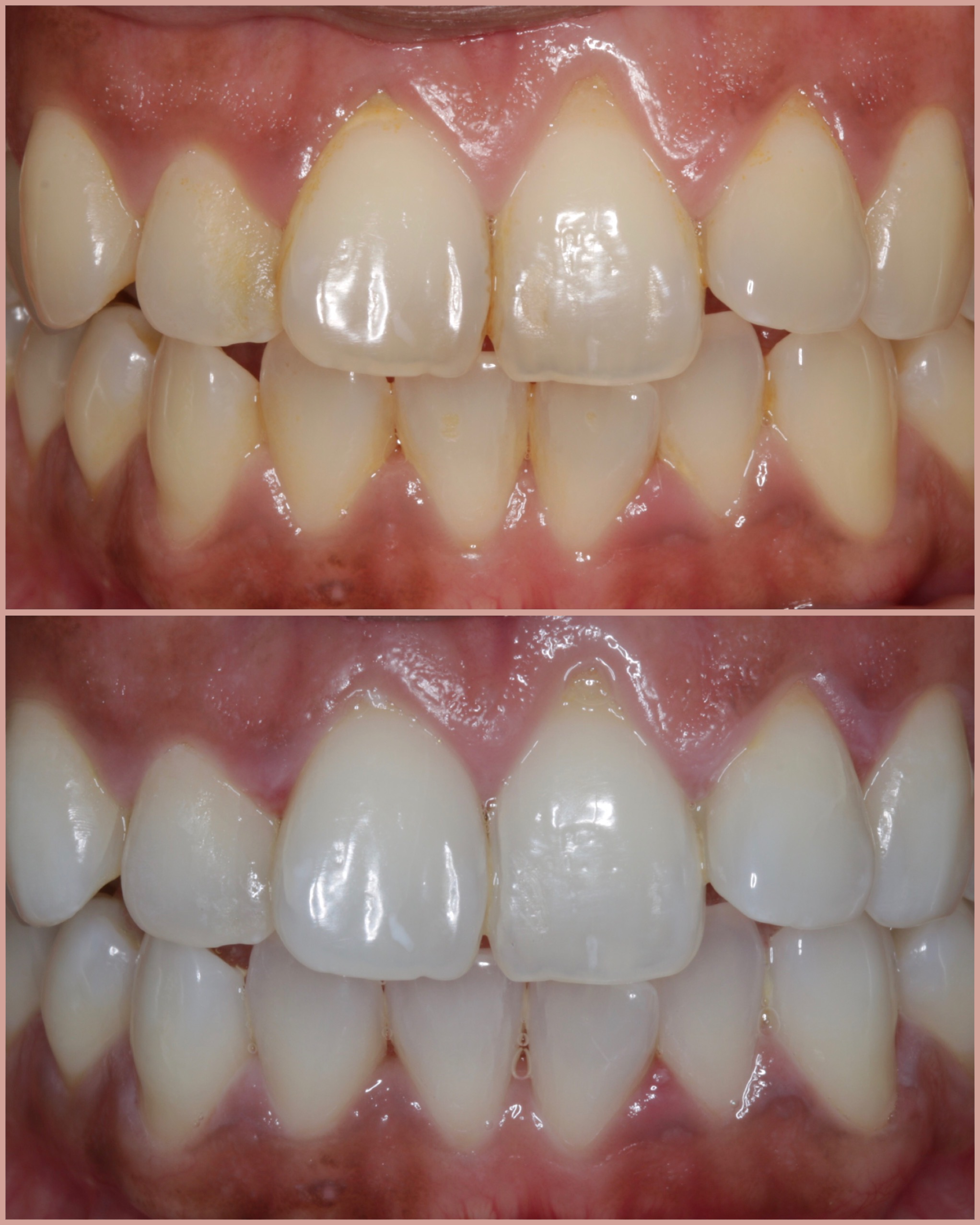 After LumiWhite whitening 2